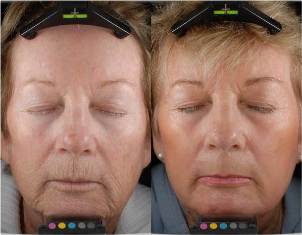 Before and after rejuvenation with fractional laser